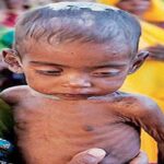Cases-of-malnutrition-FILE.jpg